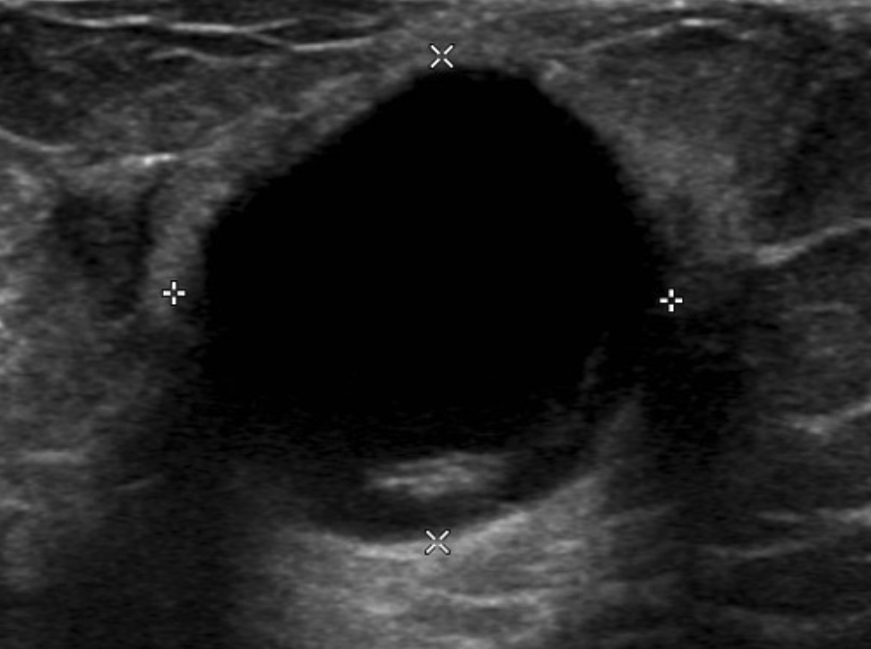 Breast Cysts