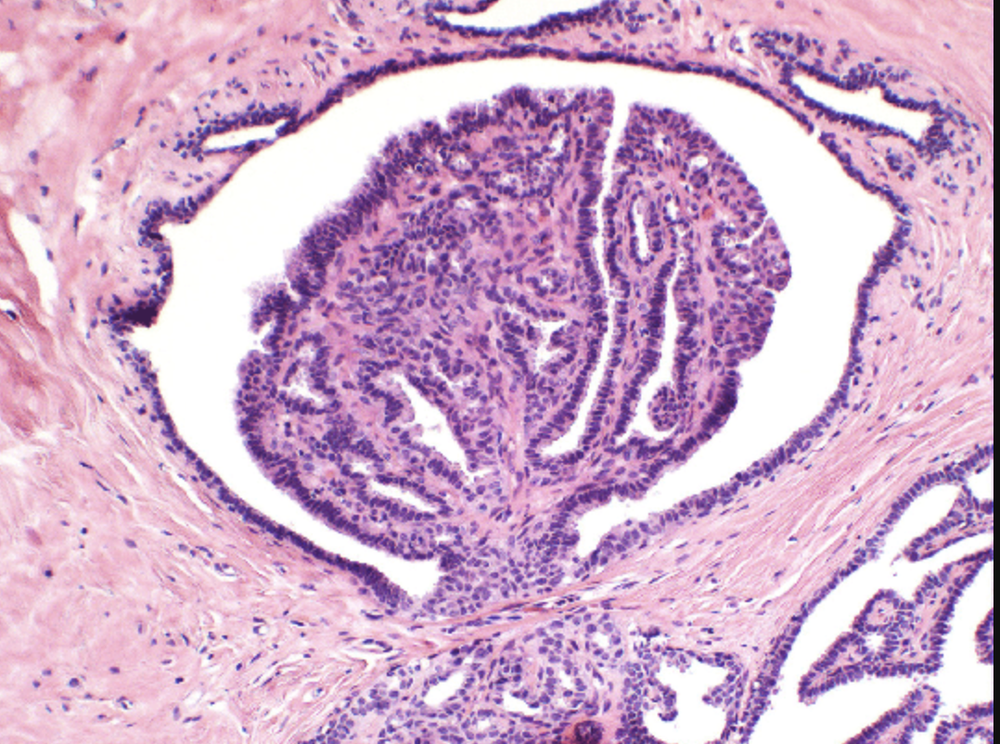 Breast Papillomas
