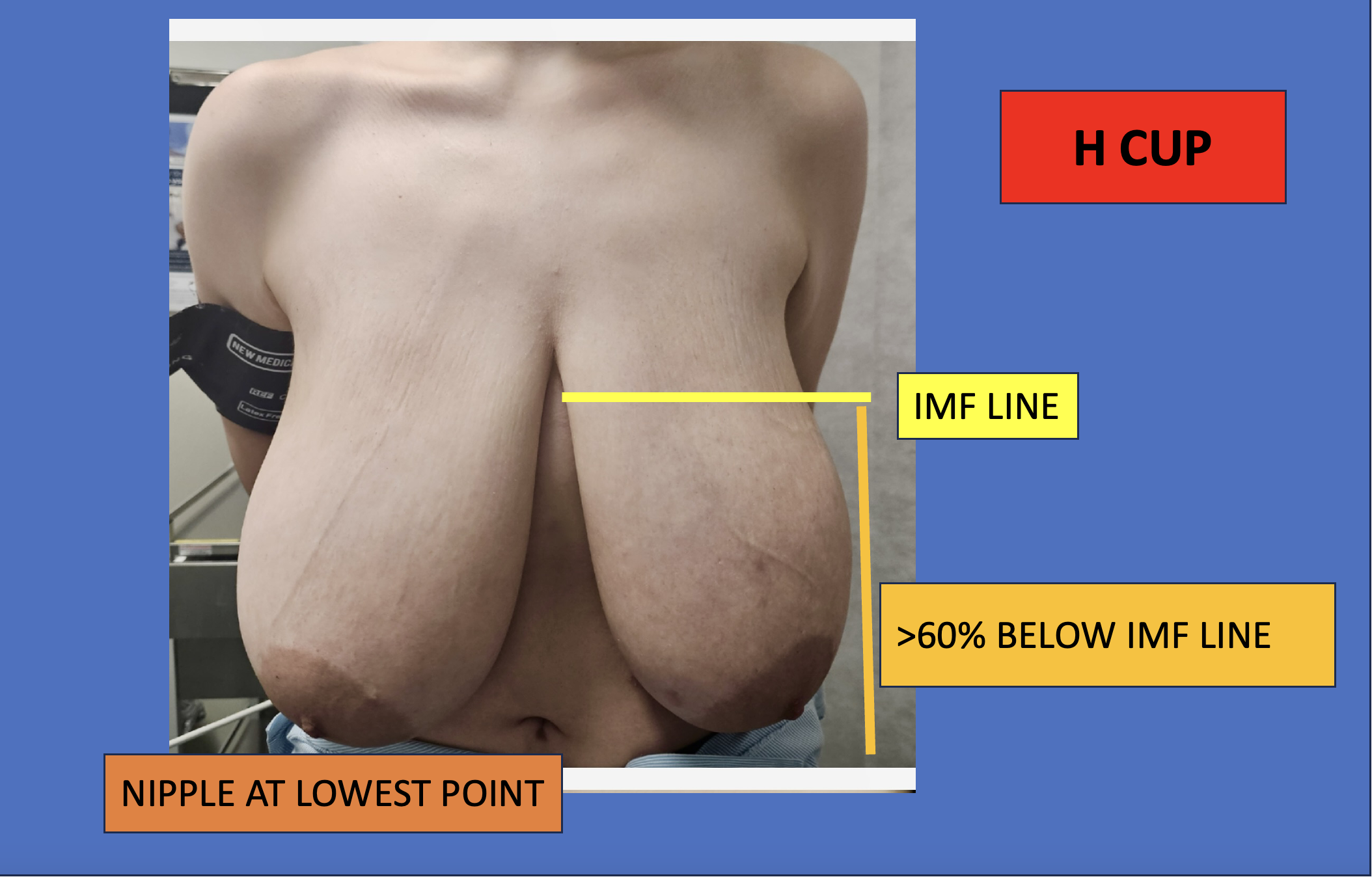 Preoperative+macromastia+breast+reduction.webp