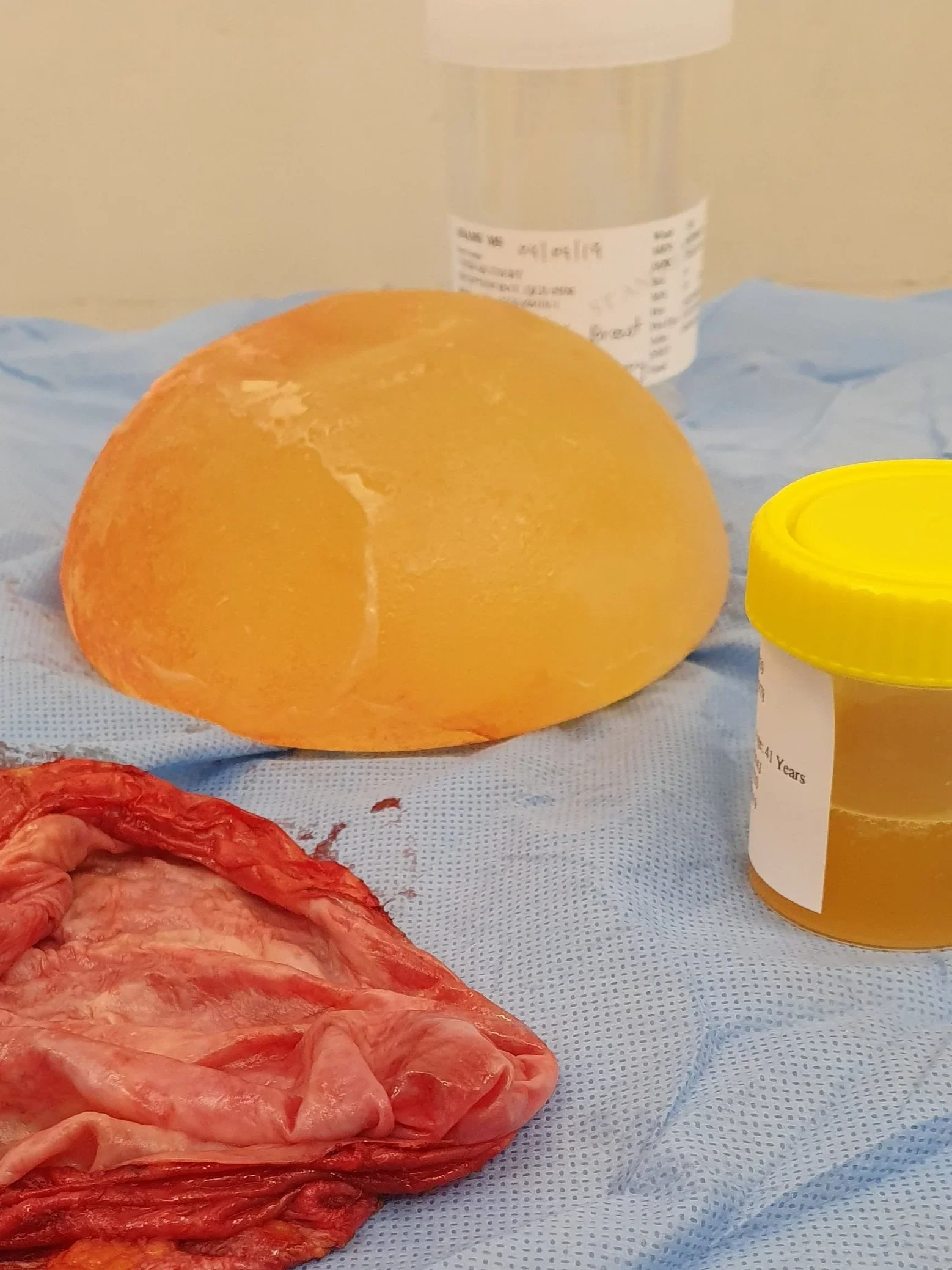 Breast Implant Removal (Explantation)