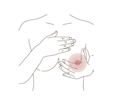 Ductal Carcinoma In Situ (DCIS)