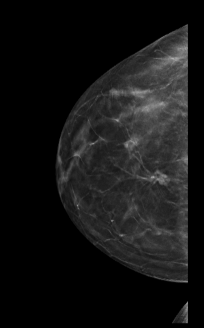 Breast Density