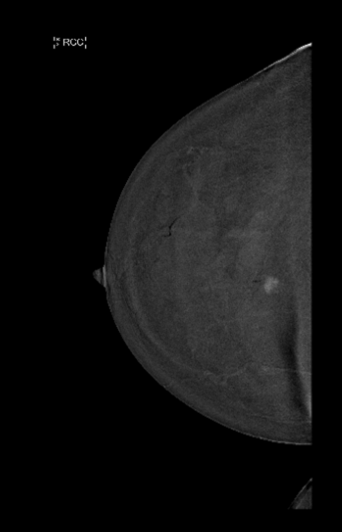 Contrast Enhanced Mammography