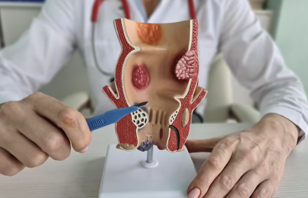 Perianal Conditions