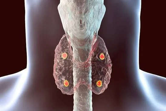 What Is Hyperparathyroidism (HPT)?
