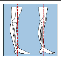 Hyperextended Knee (left) vs Knee in Healthy Alignment (right)