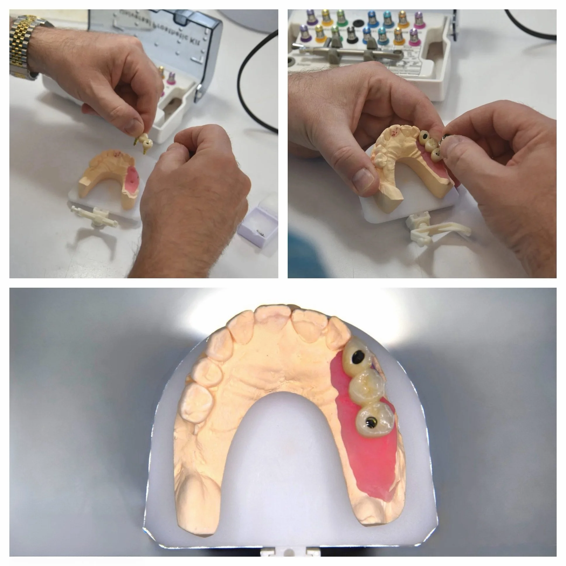 Close-up of a dental model showing a partial denture with artificial teeth, and dental tools in the background.