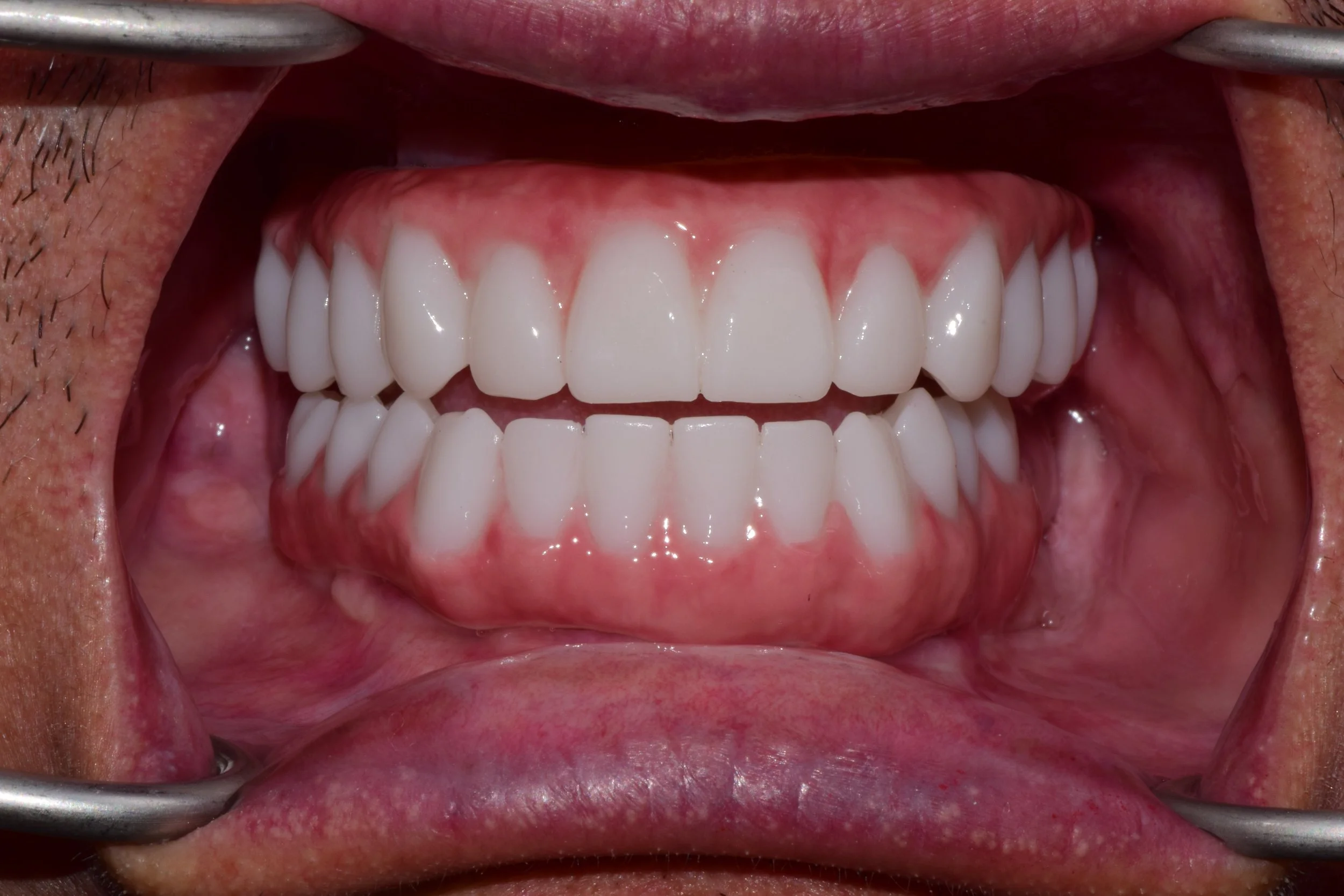 Close-up of a person's open mouth showing teeth, gums, tongue, and lips, with metal dental tools on either side.