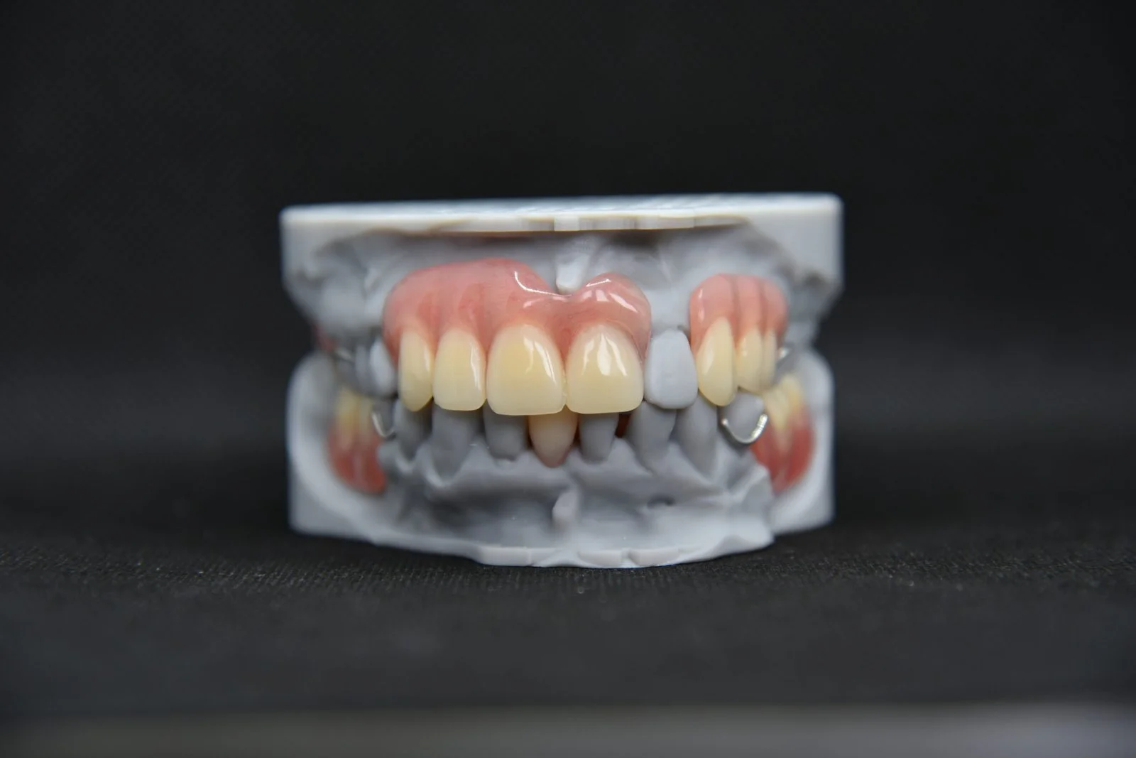 Dental prosthetic teeth set with gum and metal components on a model.
