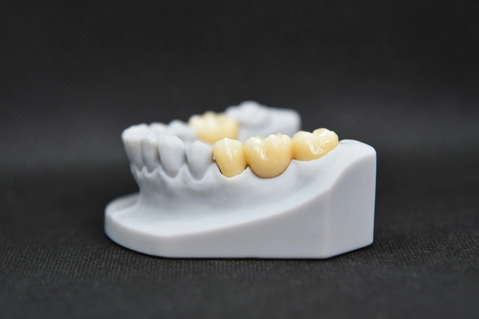 Dental model with a set of teeth, including a few dental crowns or bridges on the lower right side