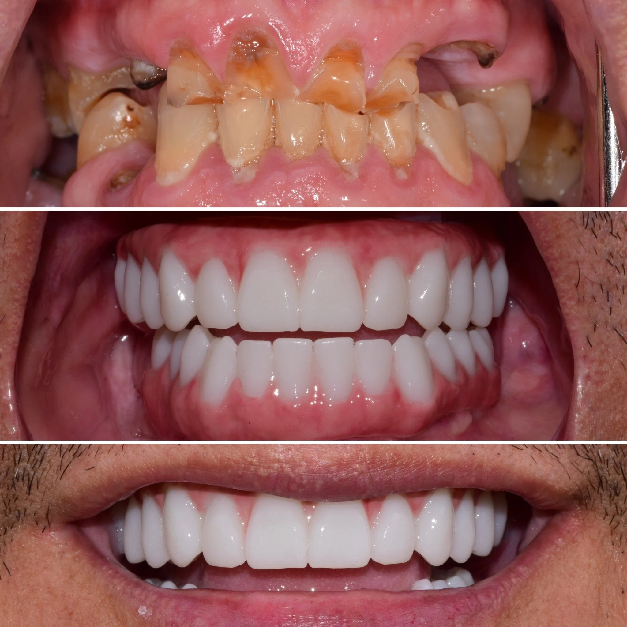 Comparison of teeth before and after dental treatment: top image shows severely decayed and discolored teeth; bottom image shows healthy, white, and well-aligned teeth.