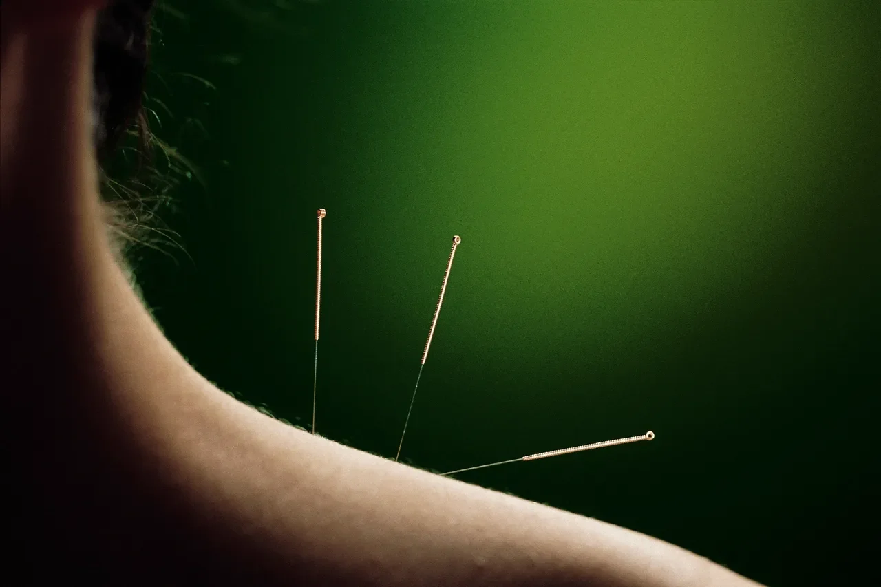 Dry Needling: Learnings &amp; Insights