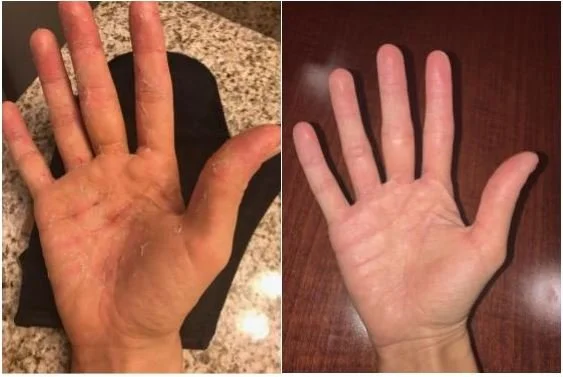 Comparison of two hands, with the left hand appearing dry and cracked, and the right hand looking smooth and healthy.