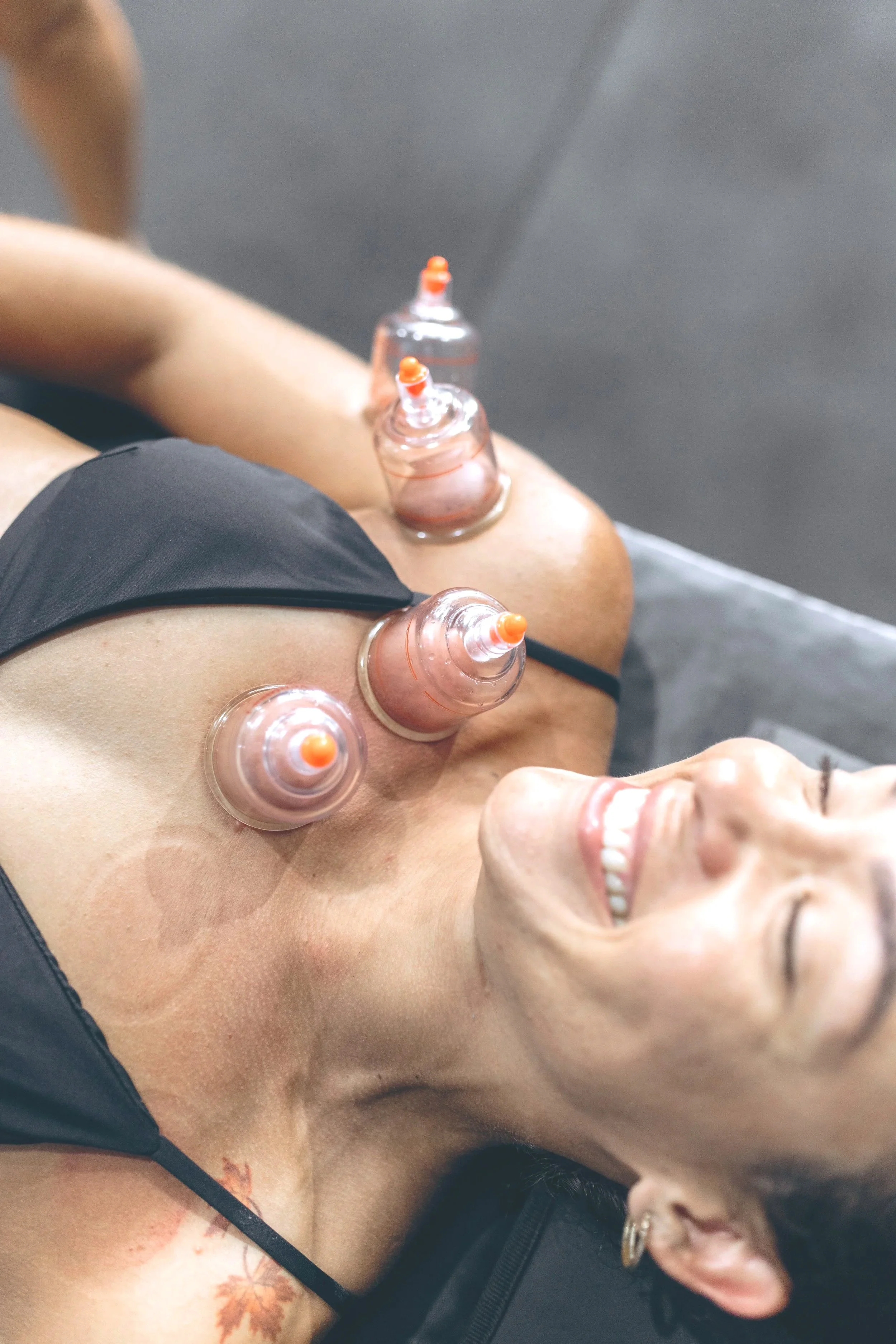 Person receiving acupuncture treatment with multiple small plastic cups placed on their shoulder, smiling and lying down.