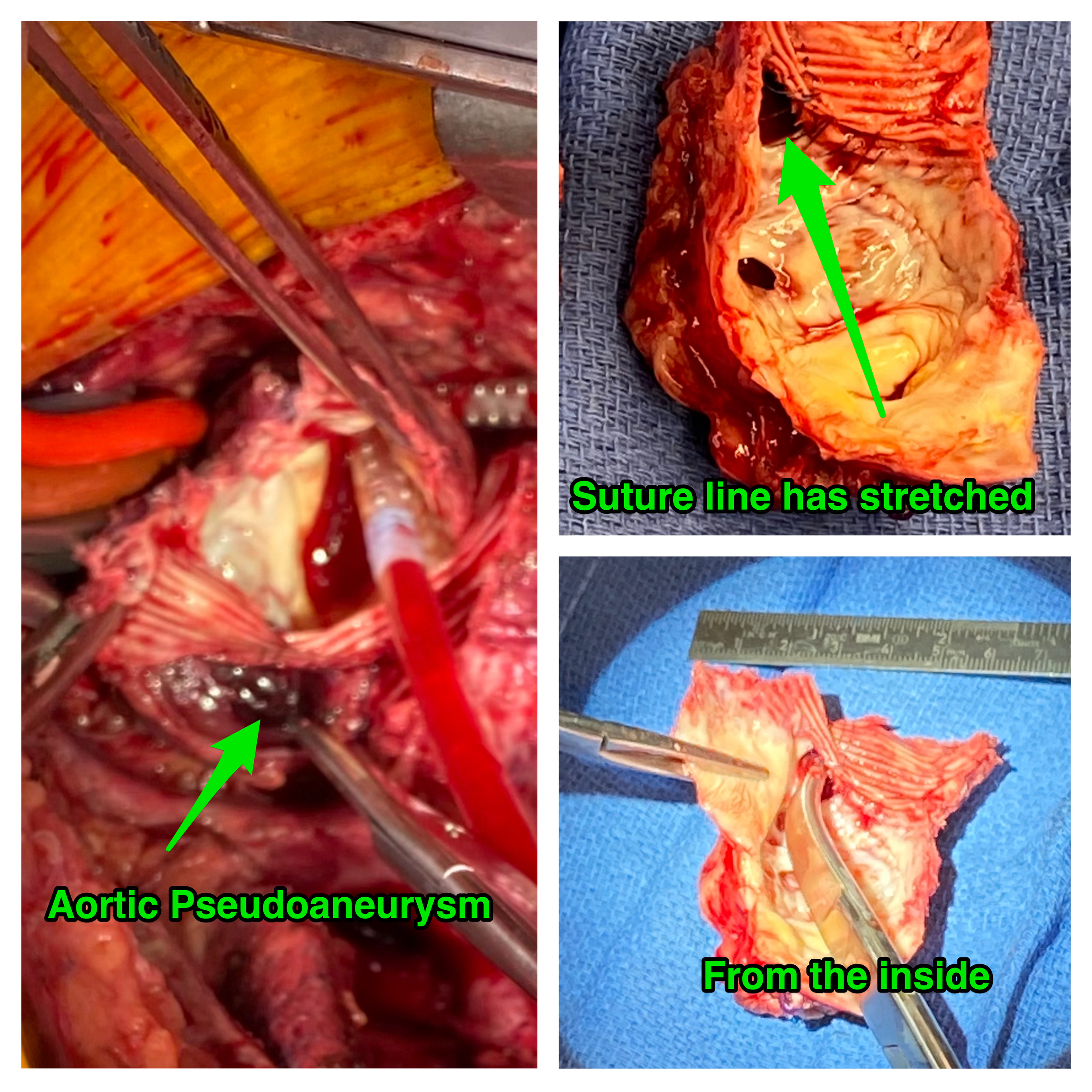 Aortic graft pseudoaneurysm