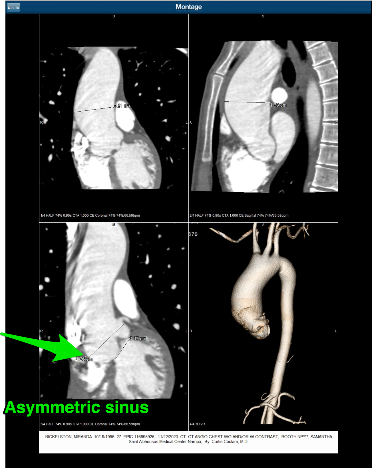 asymmetric sinus of valsalva