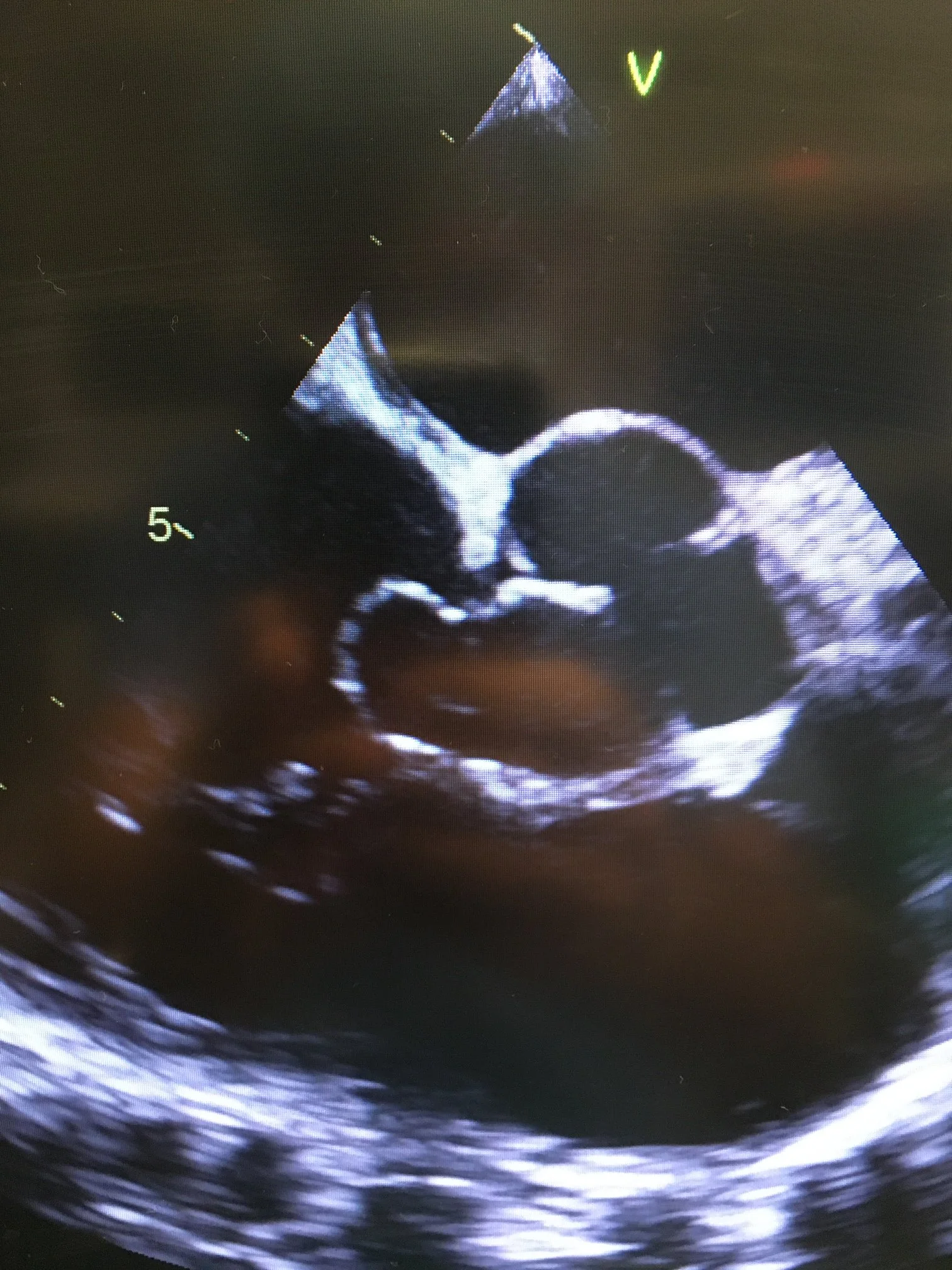 sinus of valsalva
