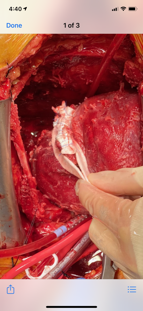 Left Ventricular pseudoaneurysm repaired