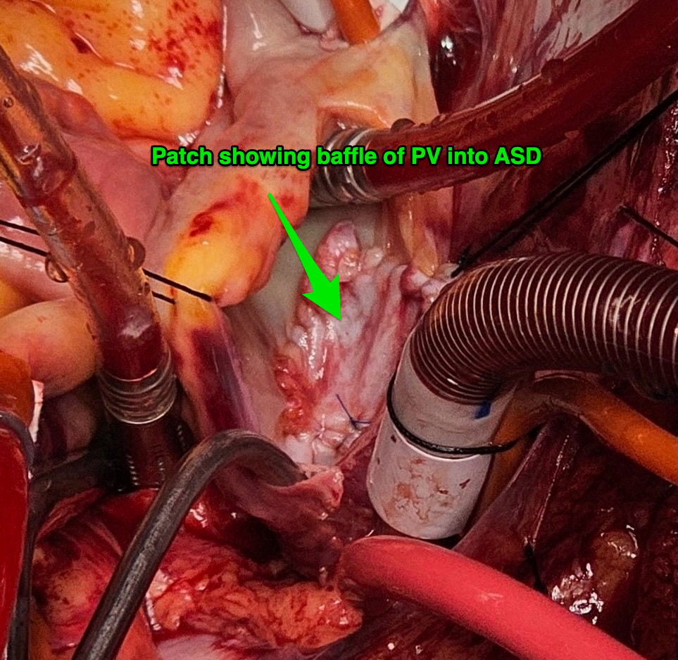 patch baffle of pulmonary vein into ASD
