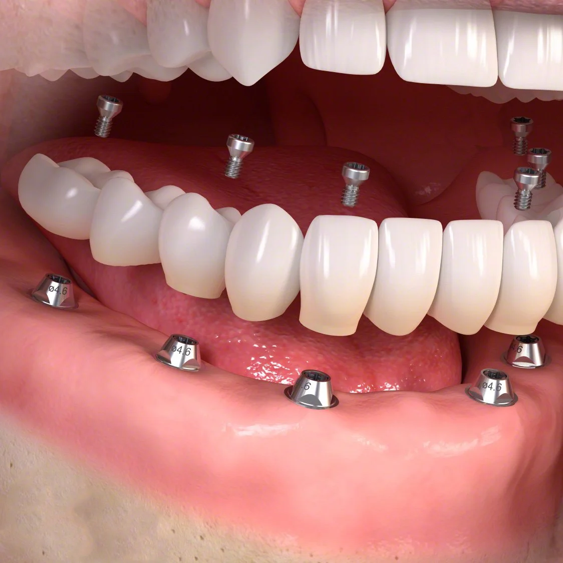 Fixed restoration with 4-6 implants all straight