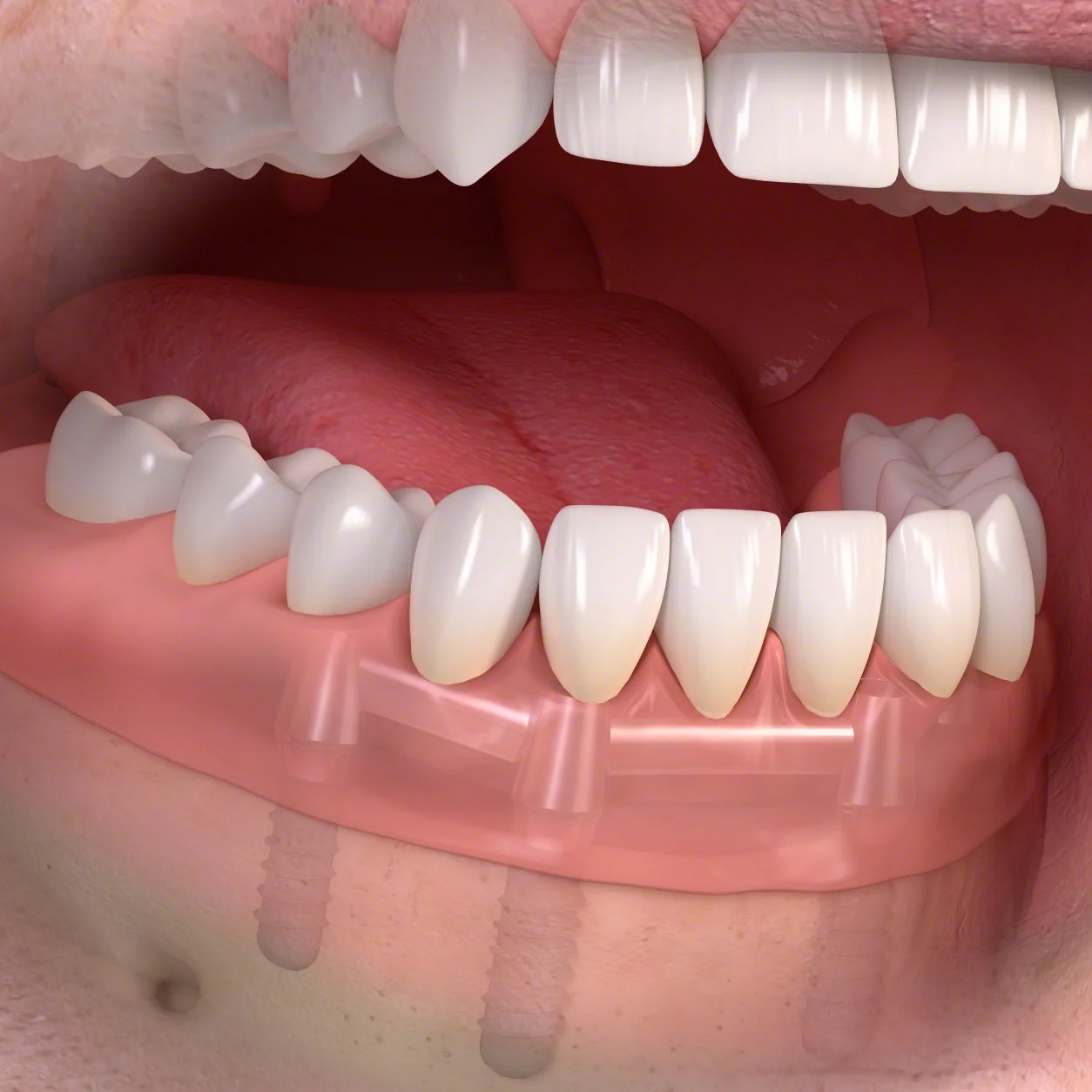 Removable denture with bar