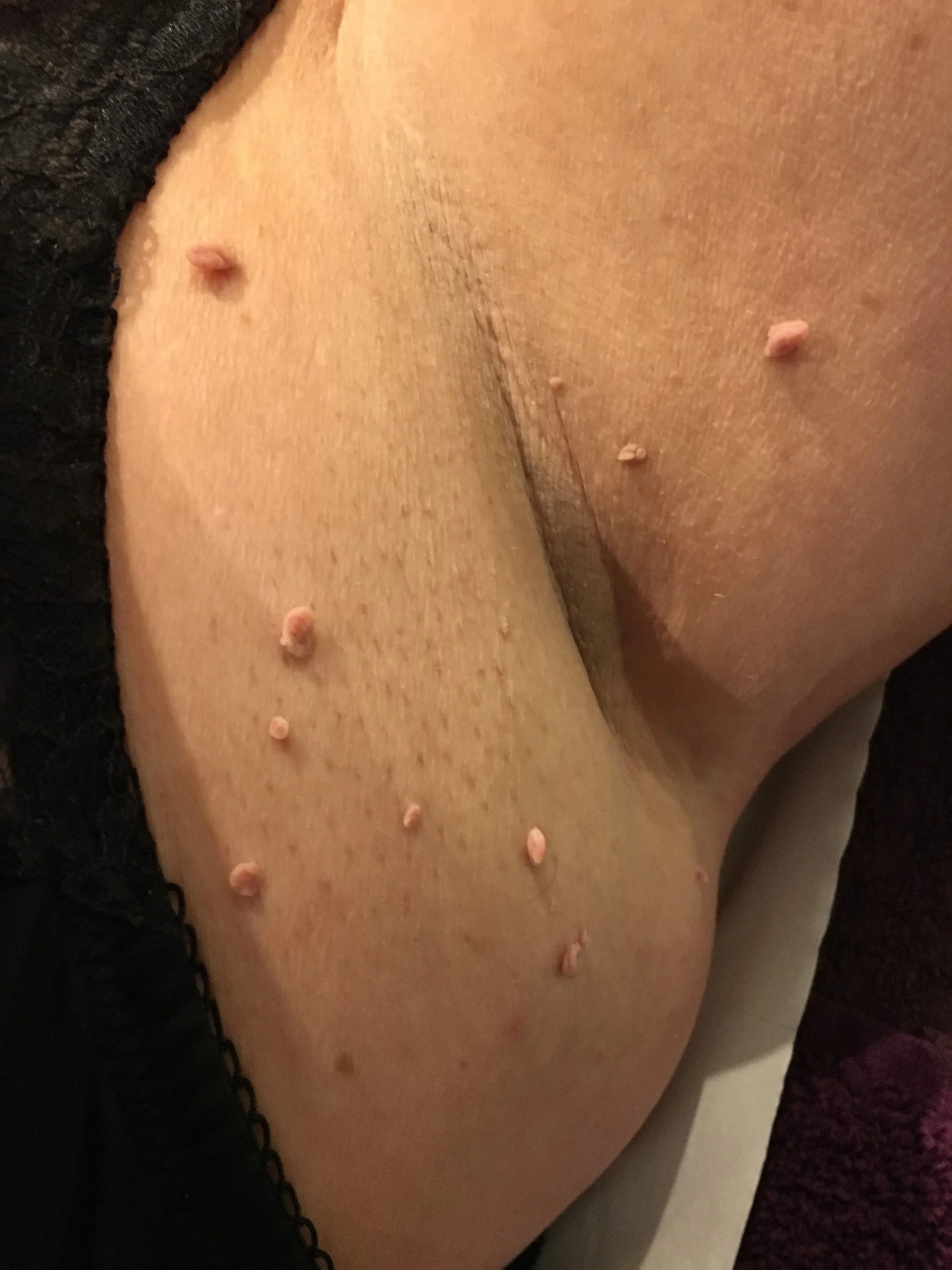 Close-up of multiple skin tags in the underarm area before treatment.