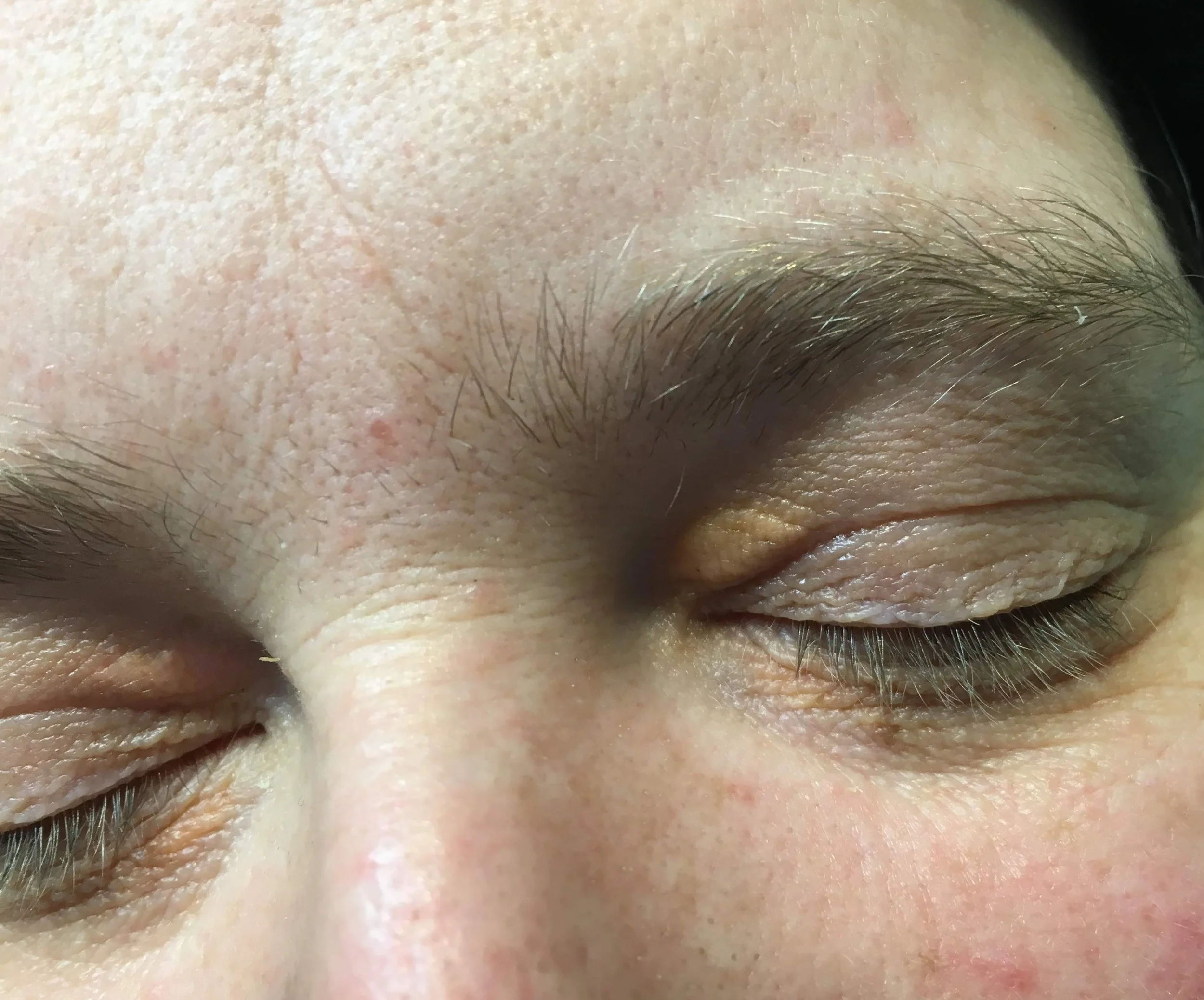 Close-up showing xanthelasma deposits around the eyes.