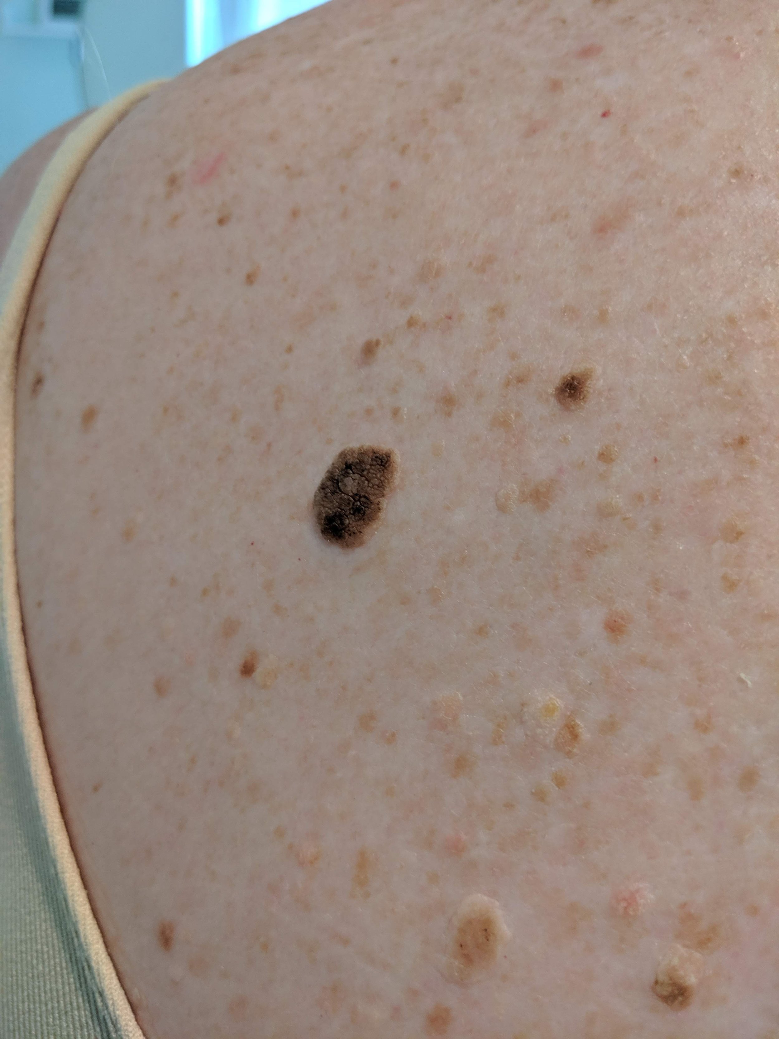 Close-up showing several seborrhoeic keratoses on the skin.