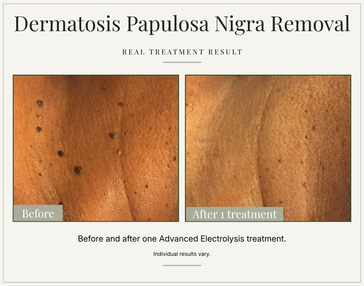 Before and after Advanced Electrolysis treatment for dermatosis papulosa nigra, showing a reduction in visible raised bumps.