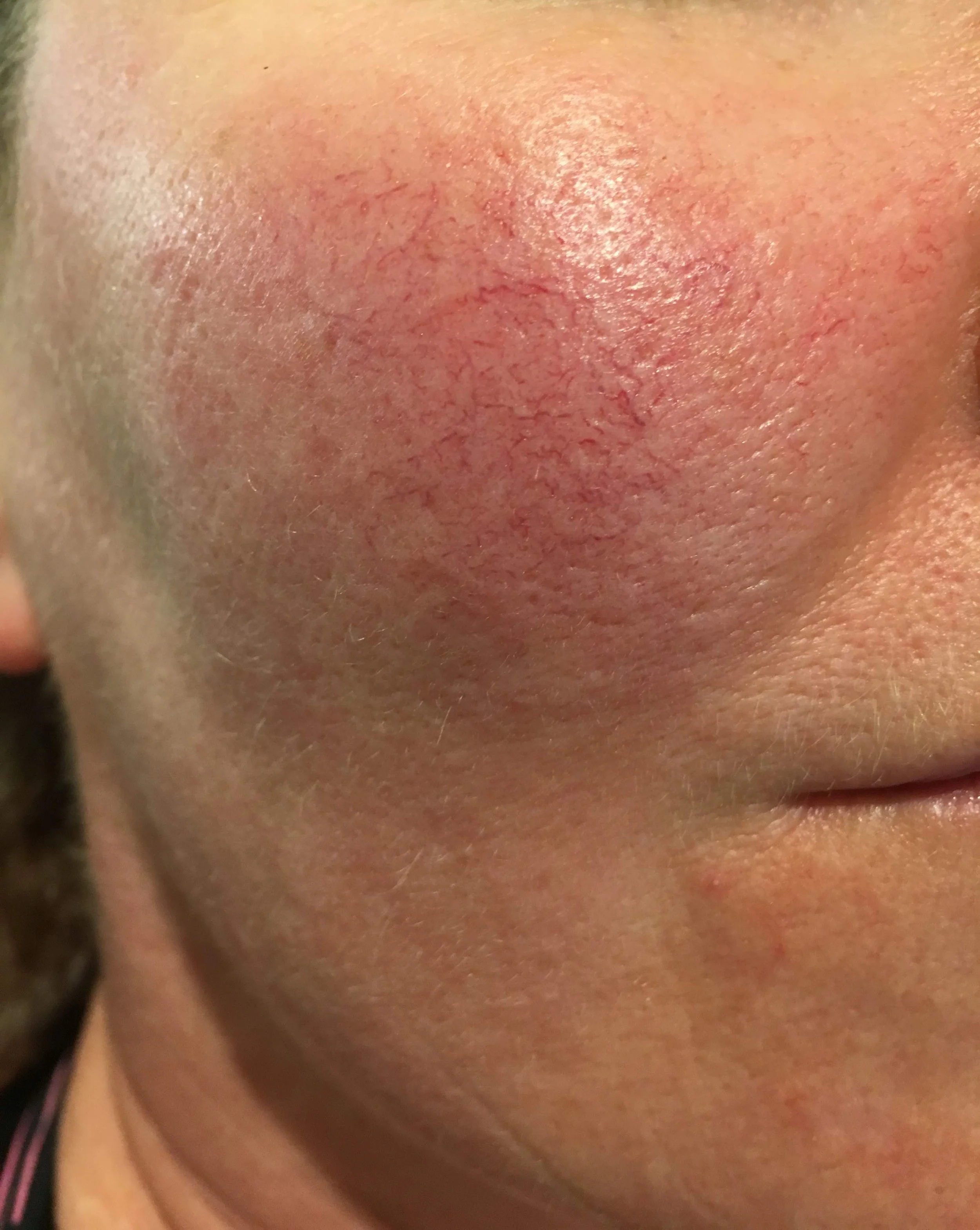 Close-up of facial thread veins and visible red capillaries across the cheek.