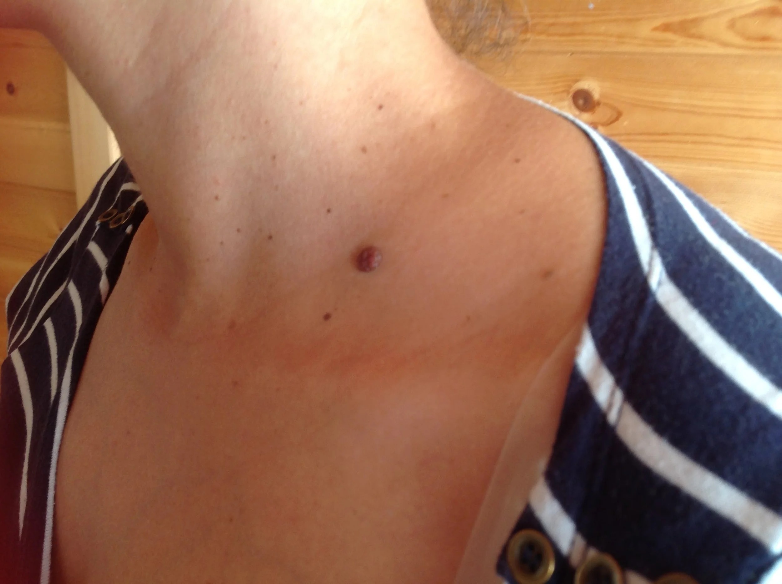 Close-up of a raised mole on the skin of the neck and upper chest.