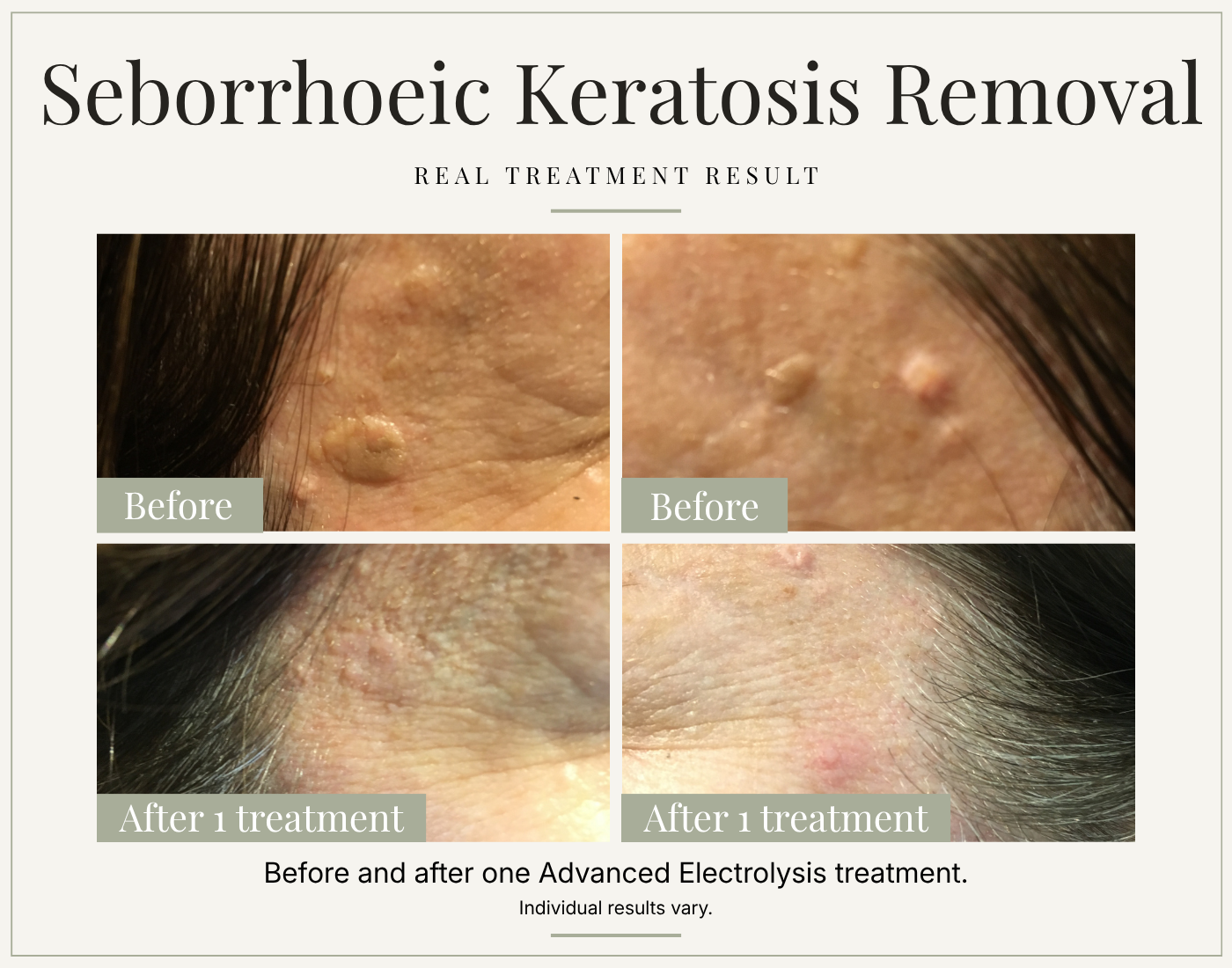 Before and after seborrhoeic keratosis removal following one Advanced Electrolysis treatment.