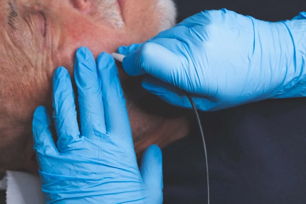 Close-up of Sarah Hurst using a fine Advanced Electrolysis probe on a client’s facial skin at her Brighton clinic.