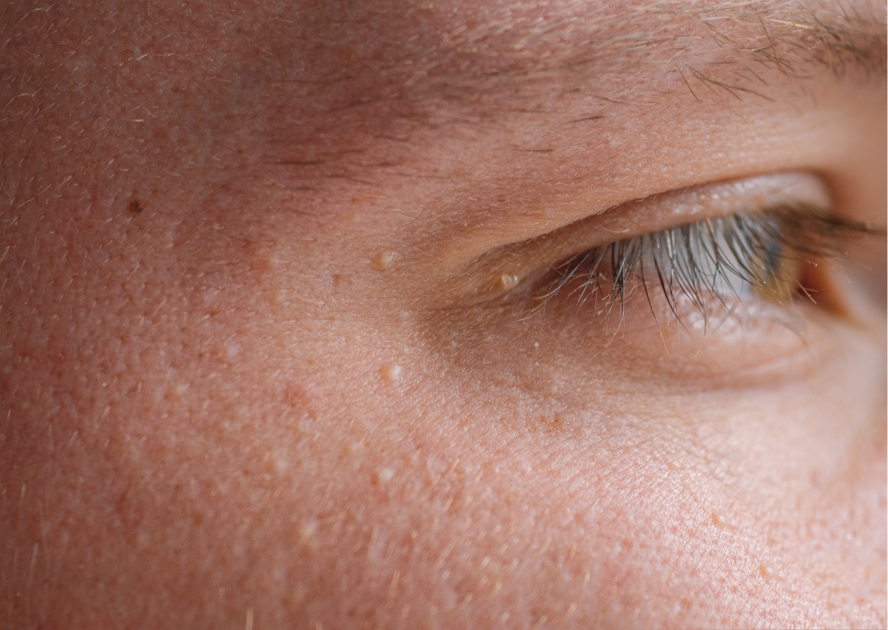Close-up of small white milia around the eye and upper cheek.