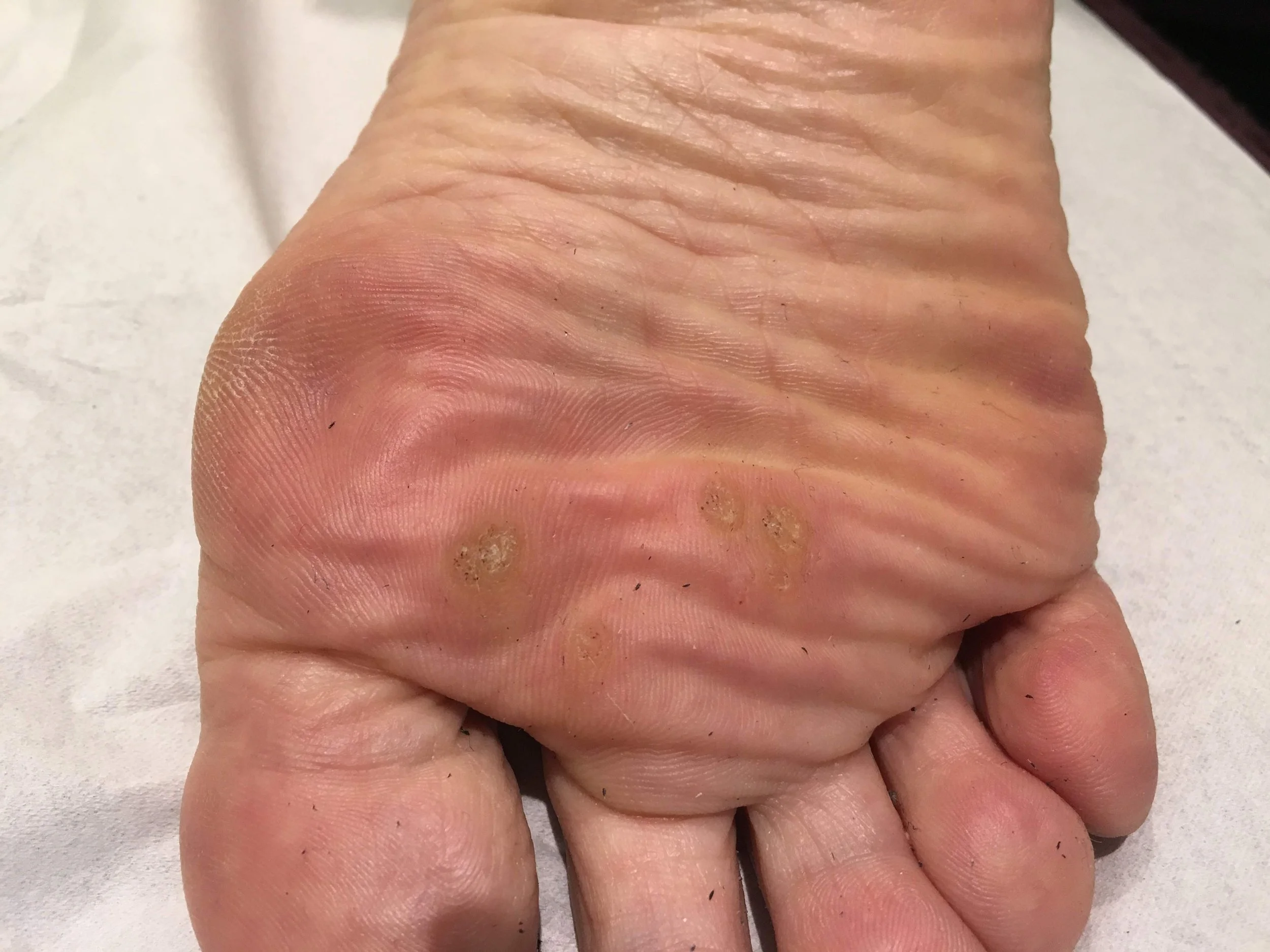 Close-up showing verrucas on the sole of the foot.