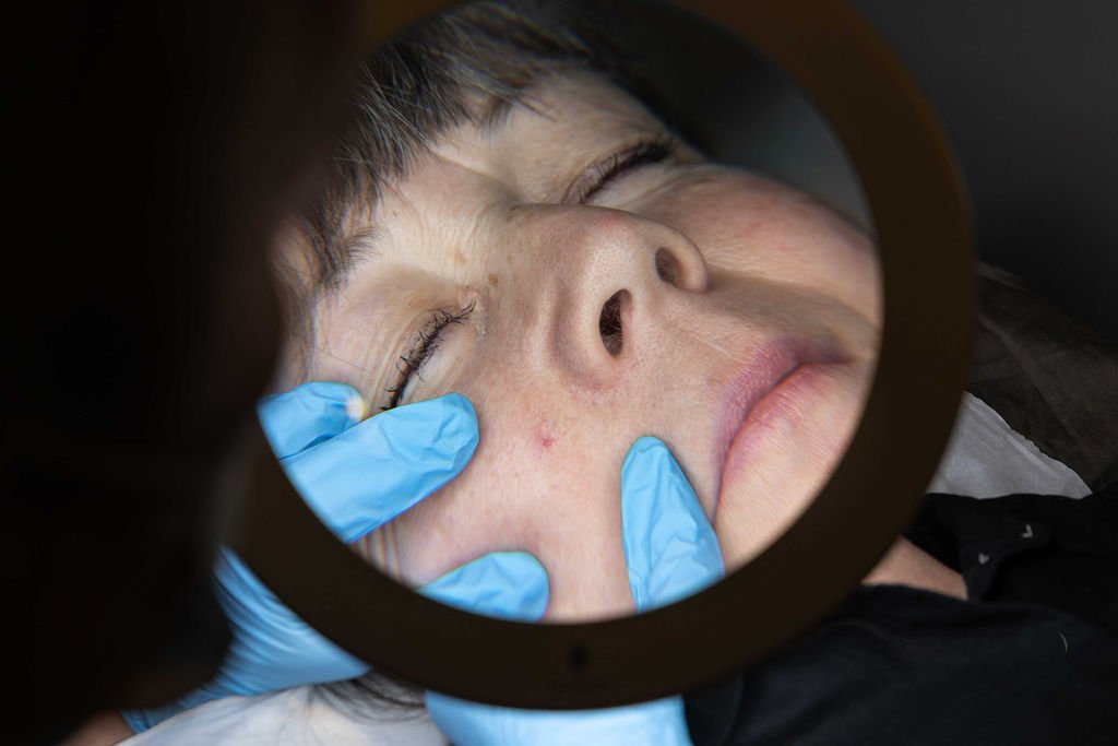 Spider naevus on a client’s cheek being examined under a magnifying lamp before Advanced Electrolysis treatment.
