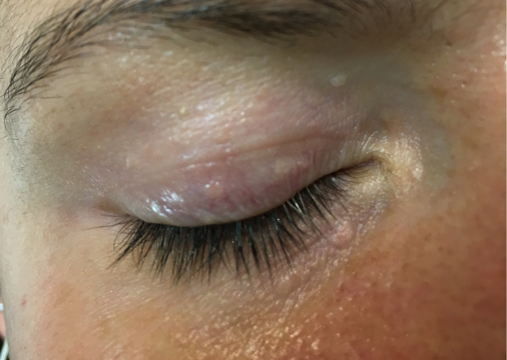 Close-up showing small, raised syringoma bumps around the lower eyelid