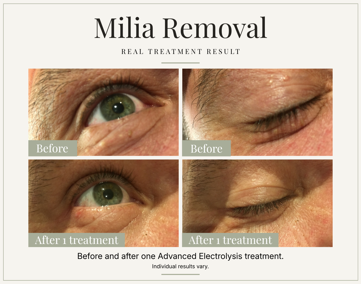 Before and after milia removal around the eye, showing improvement after one Advanced Electrolysis treatment.