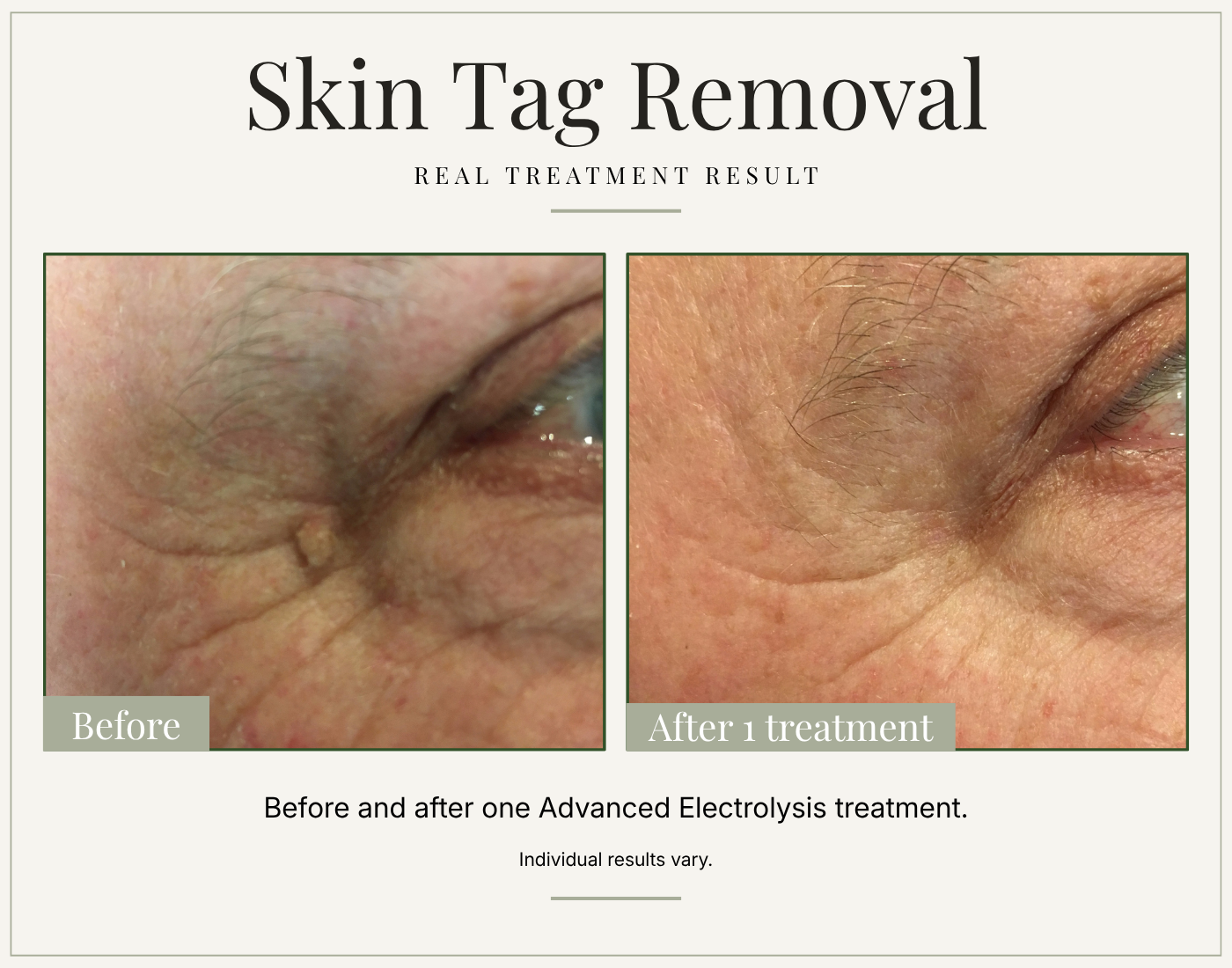 Before and after skin tag removal following one Advanced Electrolysis treatment.