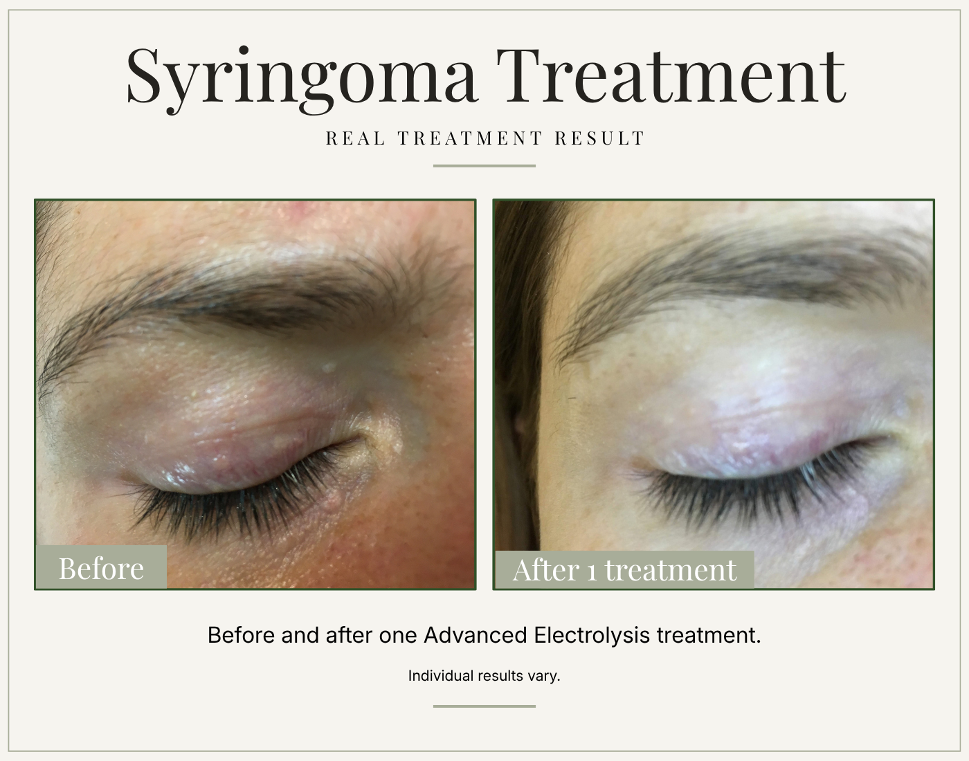 Before-and-after photographs of the eye area following Advanced Electrolysis treatment for syringomas.