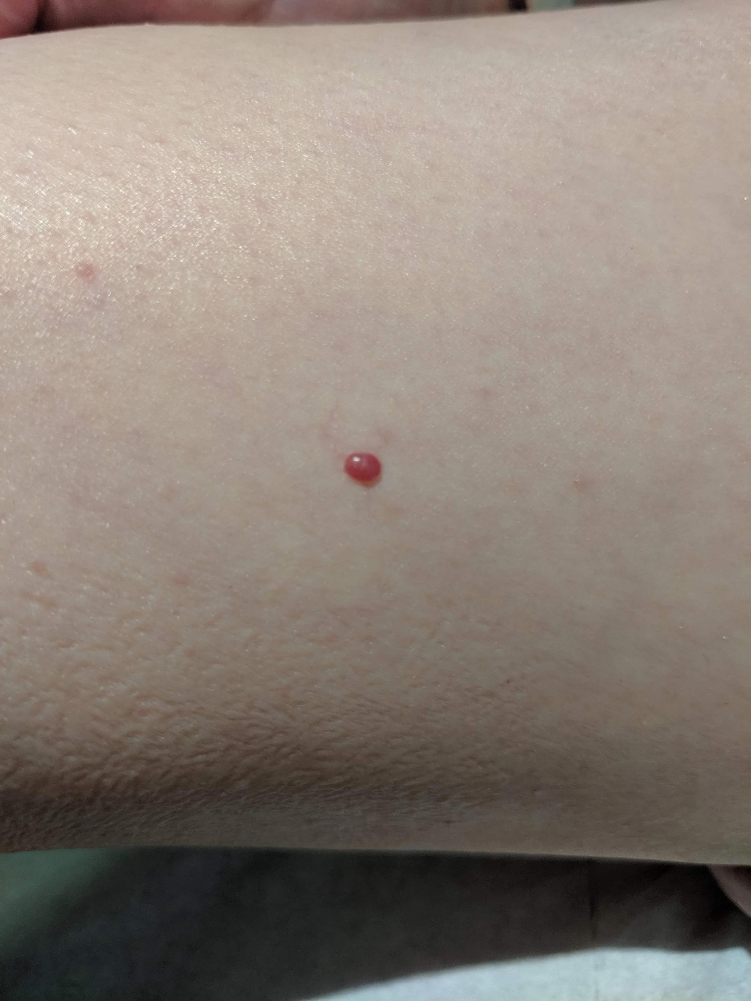 Close-up showing cherry angiomas, also known as blood spots, on the skin.