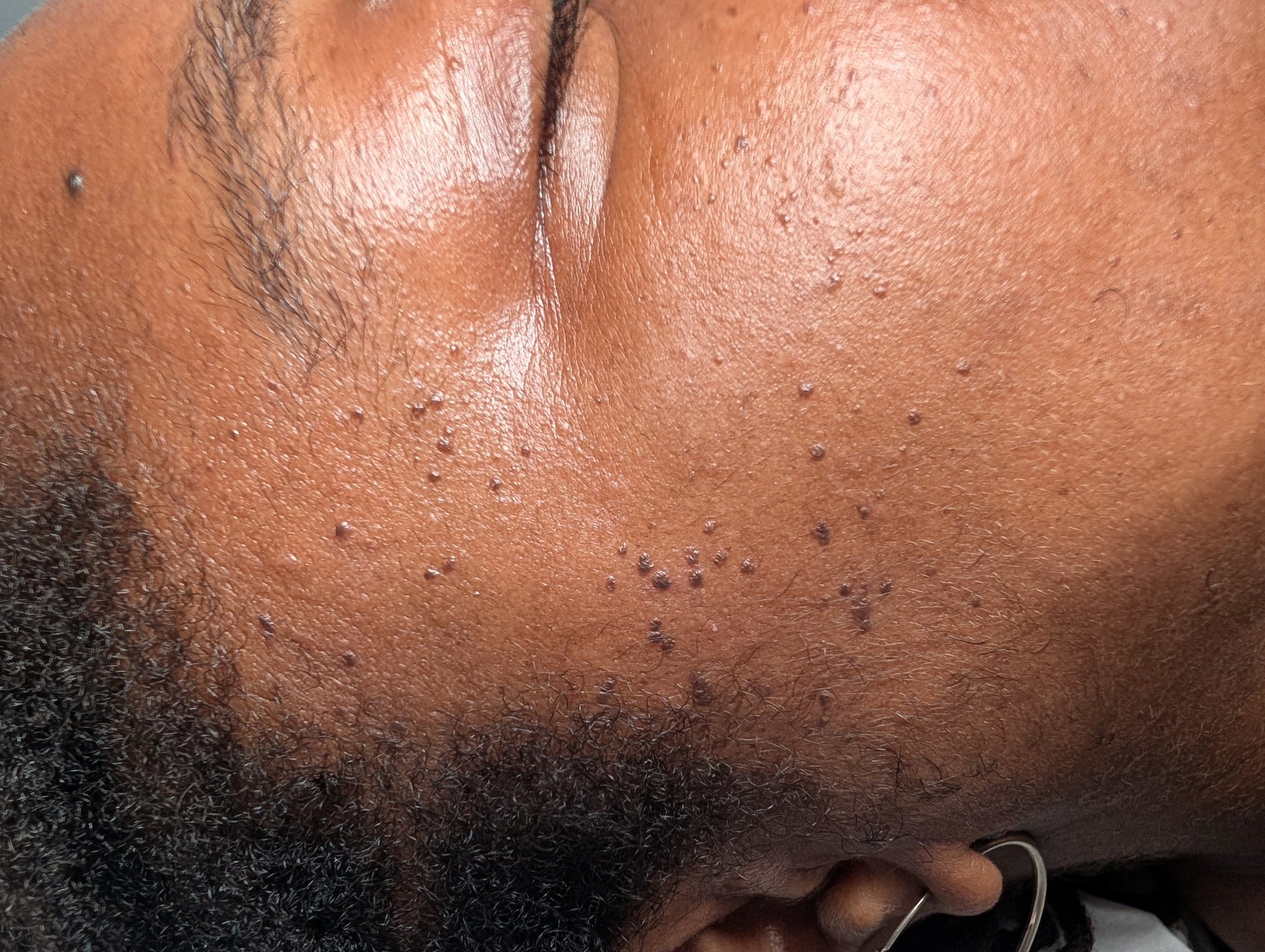 Close-up showing small, dark, raised dermatosis papulosa nigra (DPN) bumps on the facial skin.