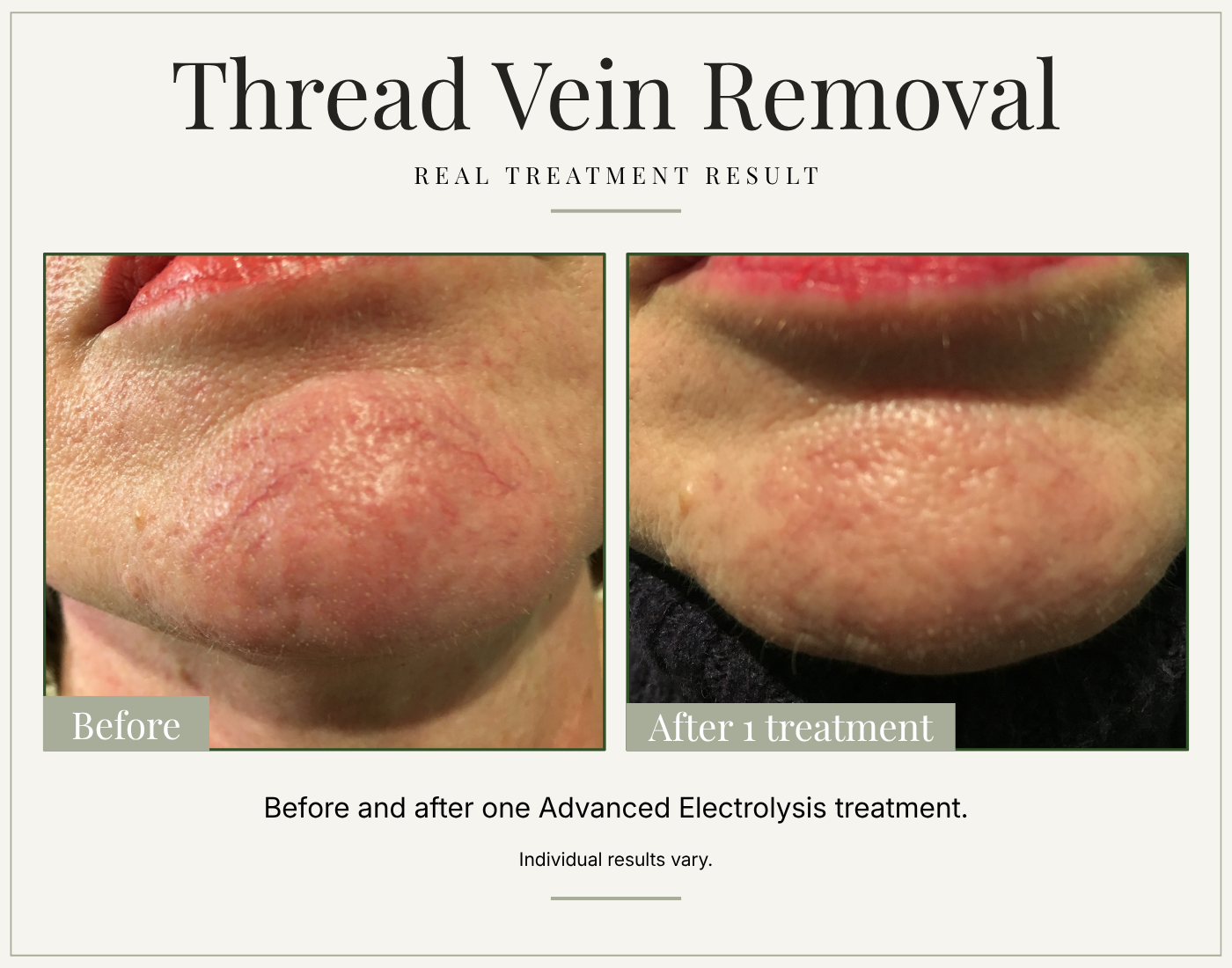 Before and after facial thread vein treatment on the chin, showing a reduction in visible red vessels.