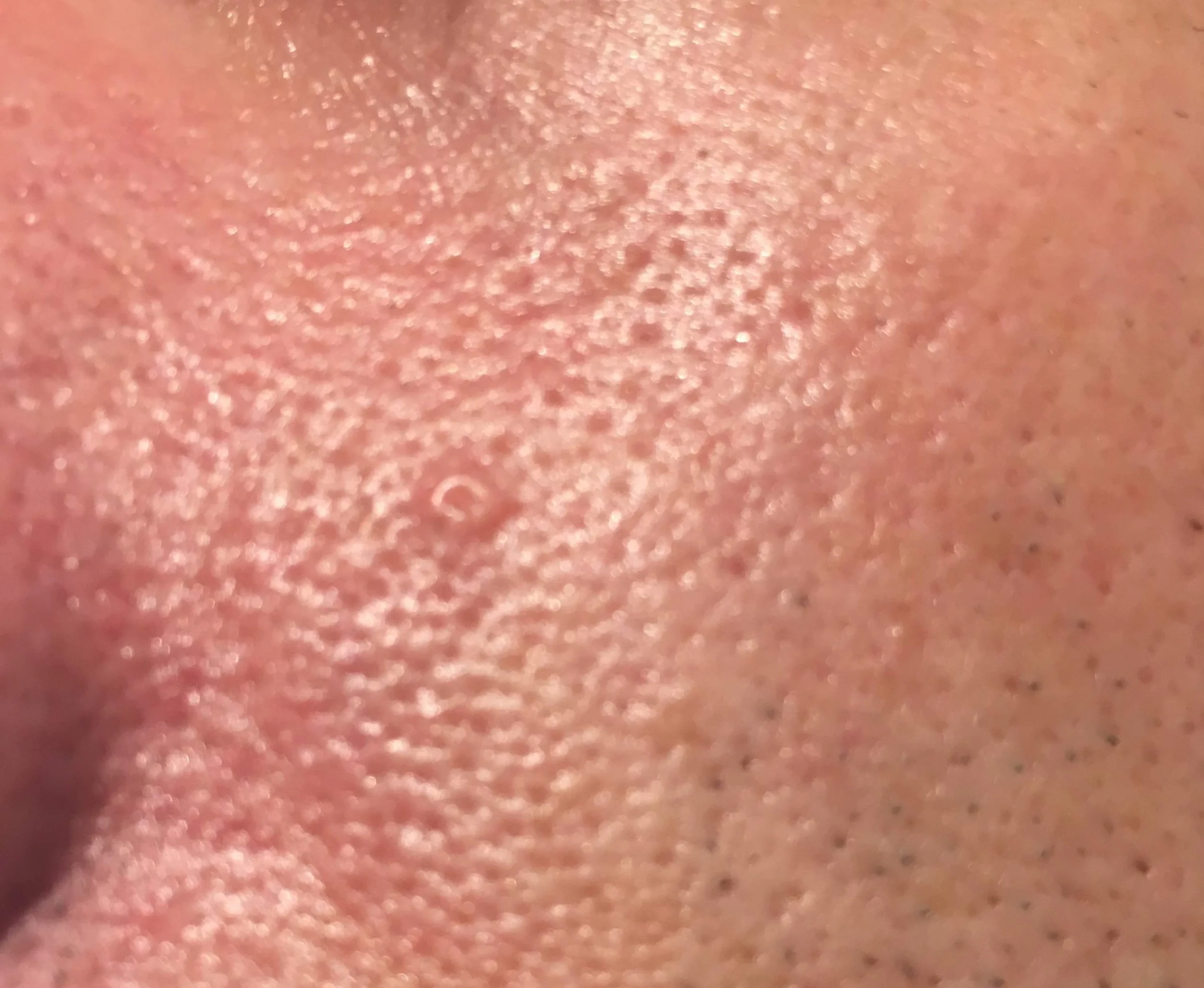 Close-up showing sebaceous hyperplasia on the facial skin.
