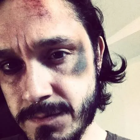 Close-up of a man with a bruise and scratch on his forehead and eye, black eye, and facial hair.
