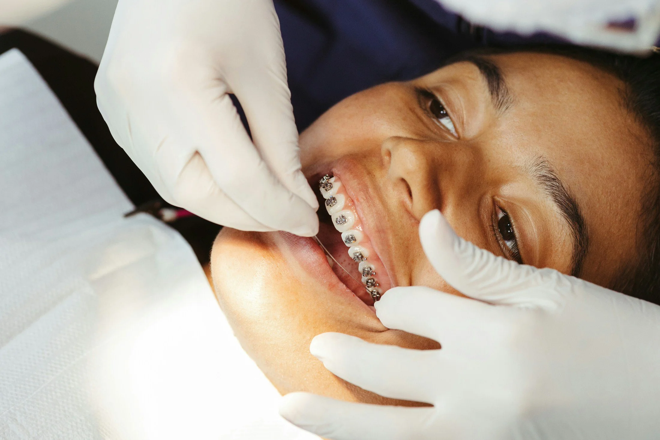 A person with braces is lying on a dental chair, receiving dental treatment from a dental professional wearing white gloves.