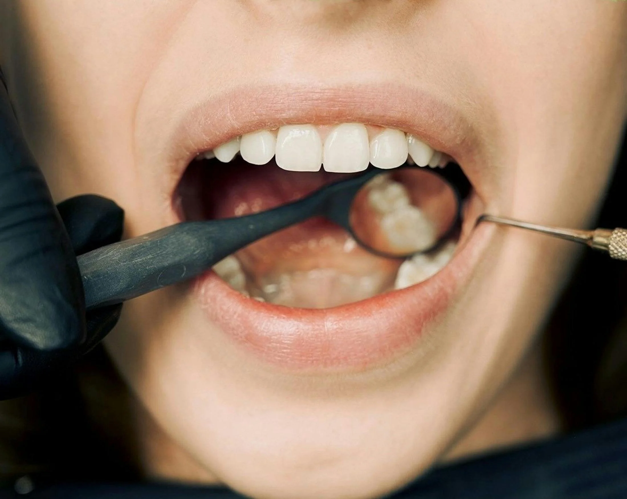 Close-up of a person's open mouth during a dental examination, showing teeth and lips, with dental tools and gloved hands visible.