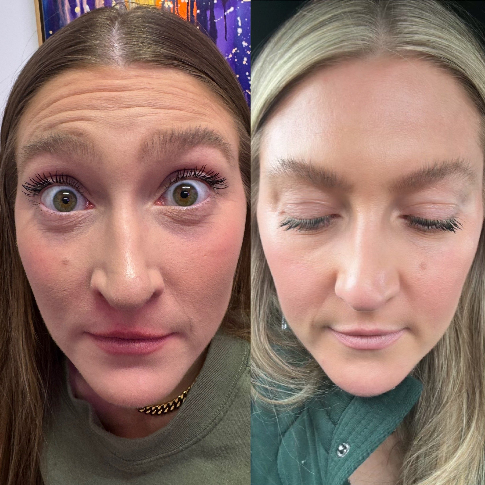 Side-by-side comparison of a woman's face showing before and after neurotoxin transformation with visibly improved wrinkles and texture.
