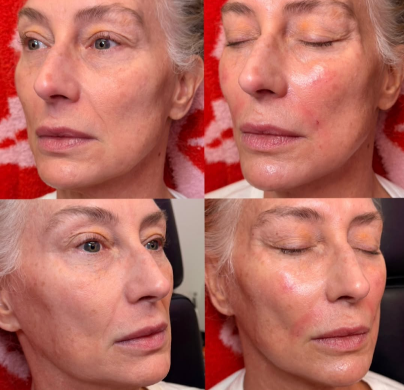 Close-up of a woman's face before and after a skincare treatment, showing improvements in skin texture and appearance.