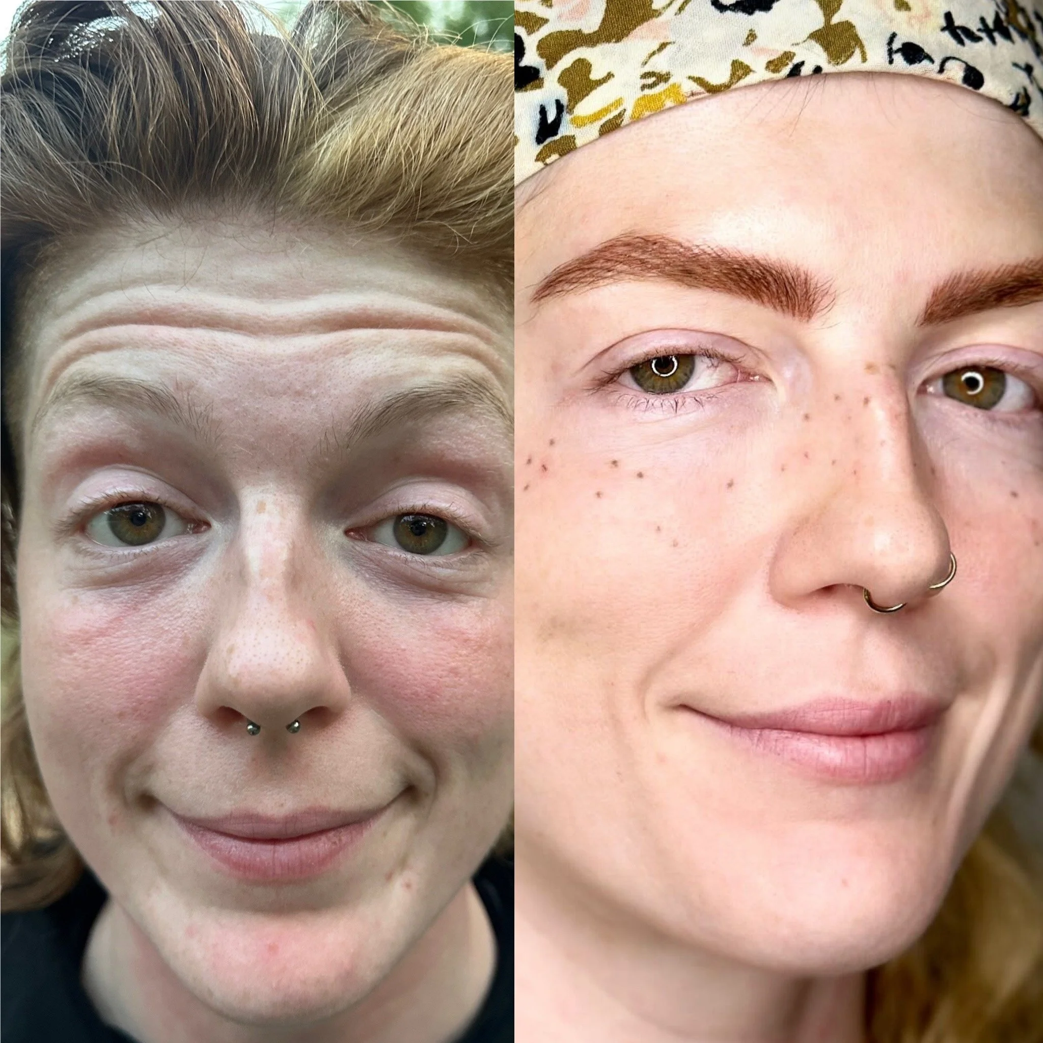 A split-screen comparison of two women's faces showing before and after neurotoxins.